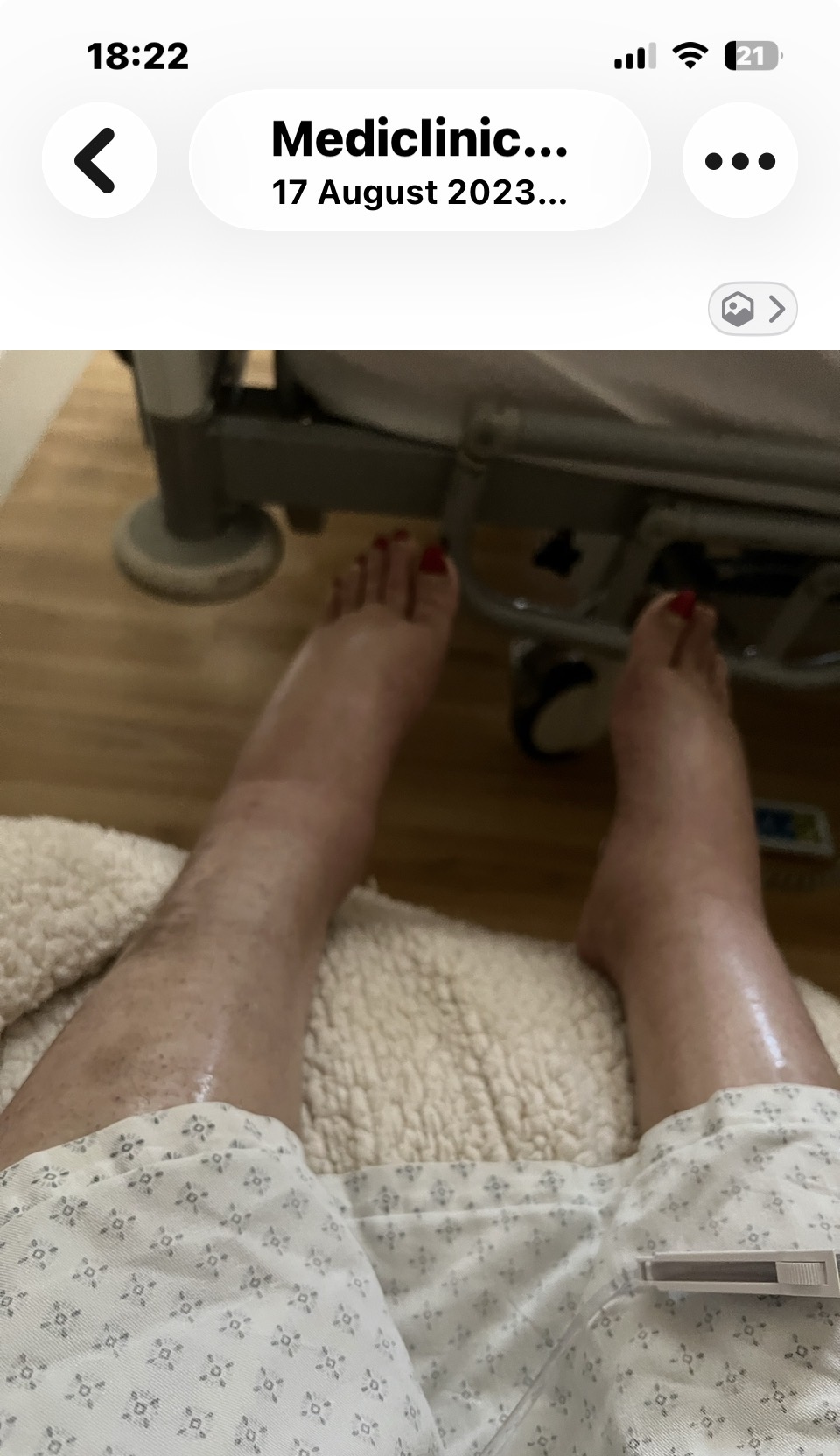 Cass's swollen legs and feet with red-painted toenails, resting on a sheepskin at the foot of the hospital bed